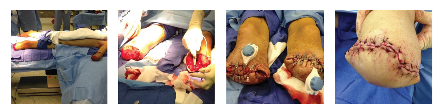 Amputation Surgery External Tissue Expander