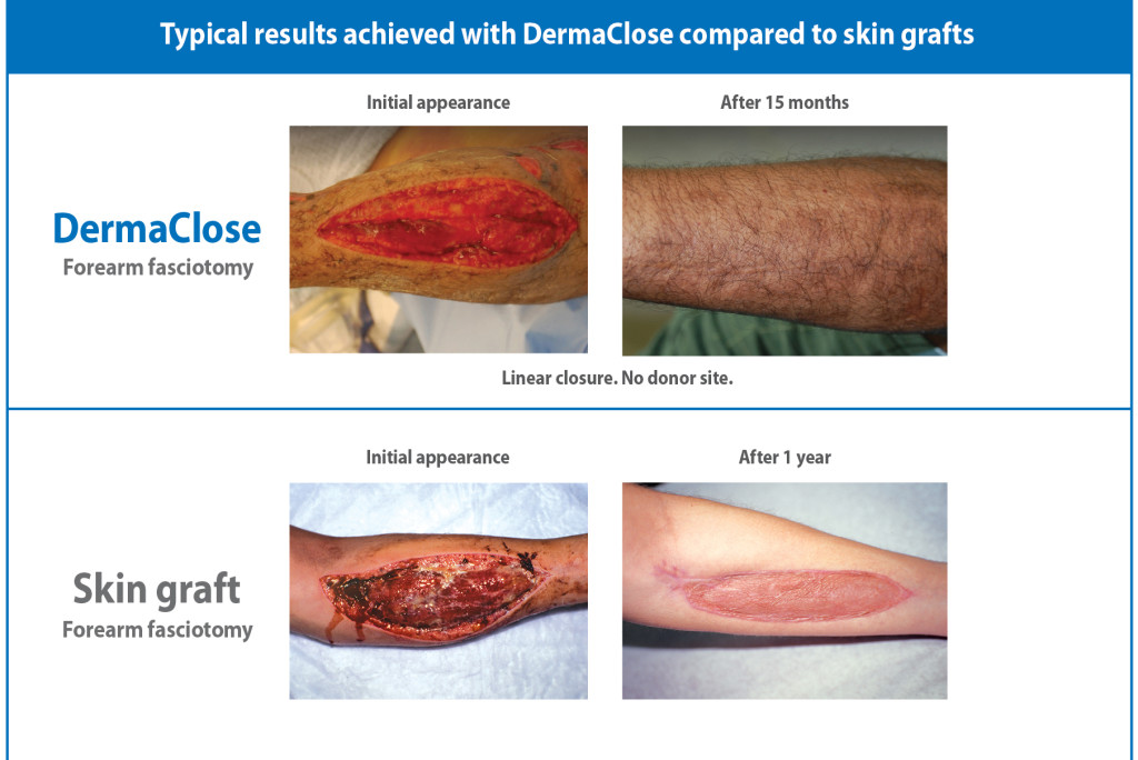 Skin graft vs DermaClose